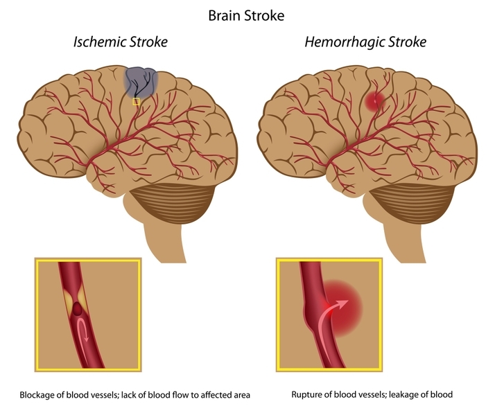 Brain stroke, eps8